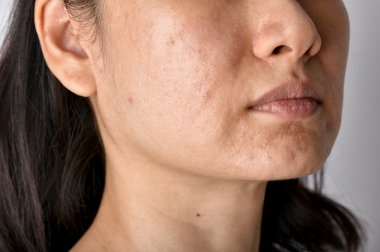 How To Get Rid of Acne Scars: Best Treatment Options & More
